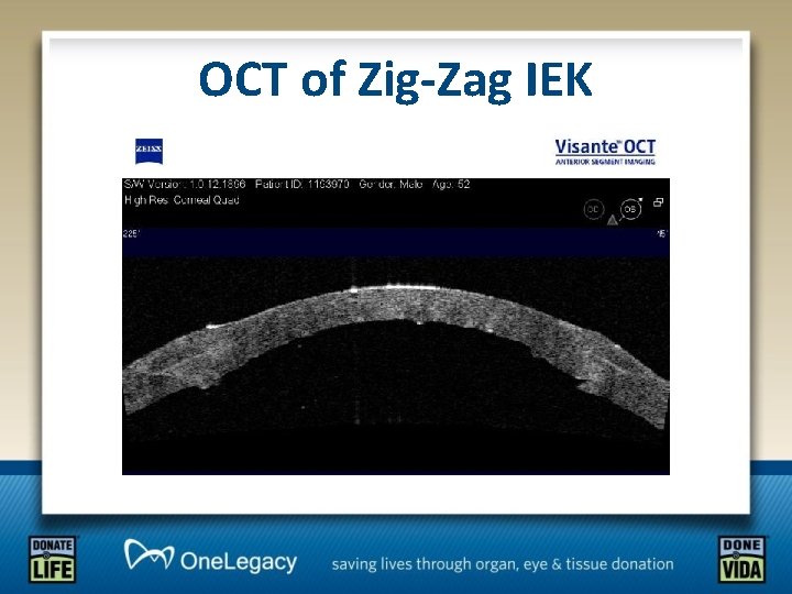 OCT of Zig-Zag IEK 