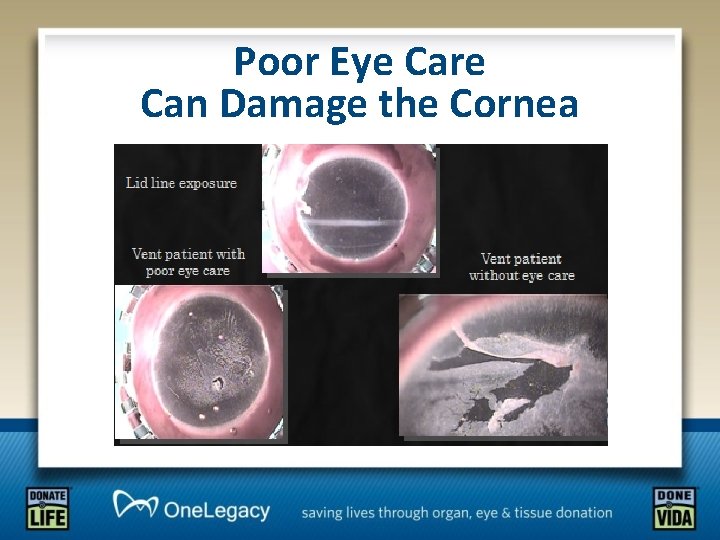 Poor Eye Care Can Damage the Cornea 