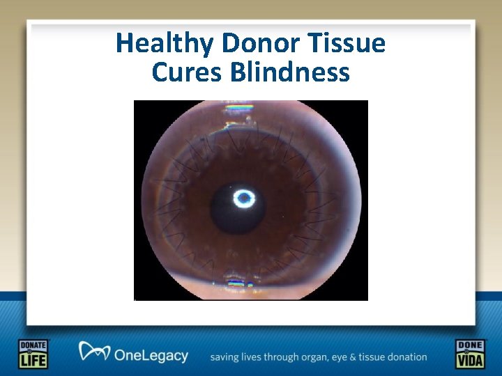 Healthy Donor Tissue Cures Blindness 