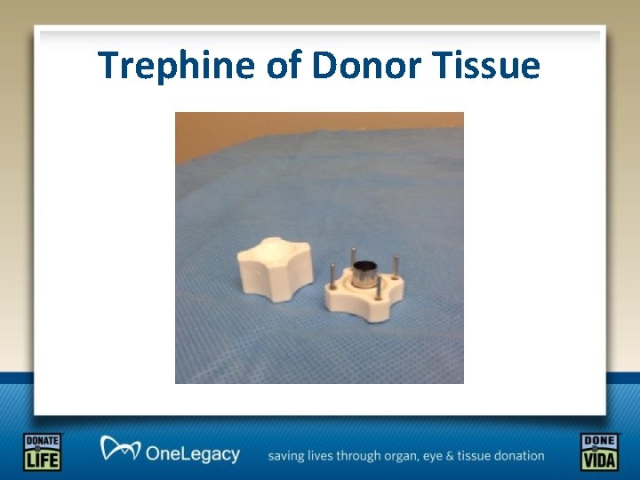Trephine of Donor Tissue 