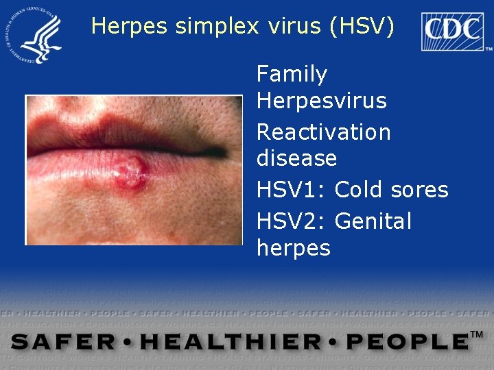 Herpes simplex virus (HSV) Family Herpesvirus Reactivation disease HSV 1: Cold sores HSV 2: