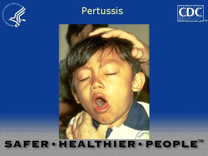 Pertussis 