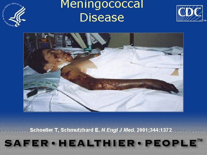 Meningococcal Disease Schoeller T, Schmutzhard E. N Engl J Med. 2001; 344: 1372 