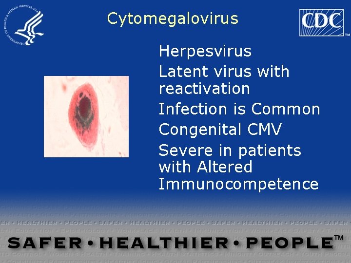 Cytomegalovirus Herpesvirus Latent virus with reactivation Infection is Common Congenital CMV Severe in patients