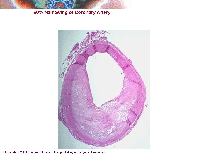 60% Narrowing of Coronary Artery Copyright © 2008 Pearson Education, Inc. , publishing as