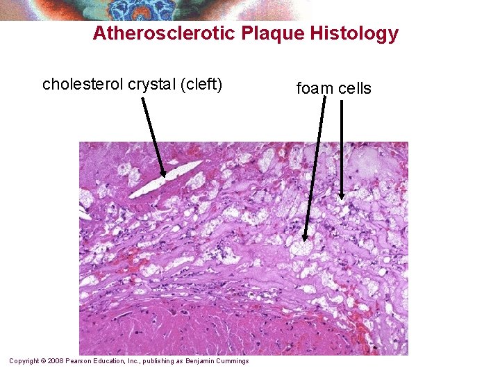 Atherosclerotic Plaque Histology cholesterol crystal (cleft) Copyright © 2008 Pearson Education, Inc. , publishing