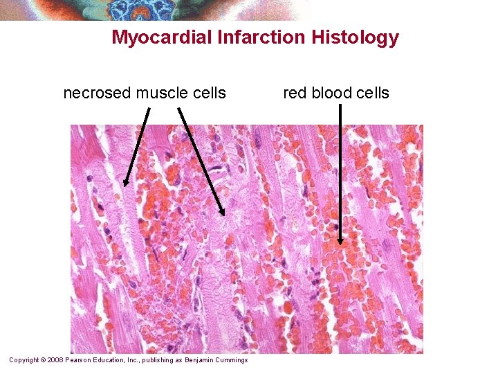 Myocardial Infarction Histology necrosed muscle cells Copyright © 2008 Pearson Education, Inc. , publishing