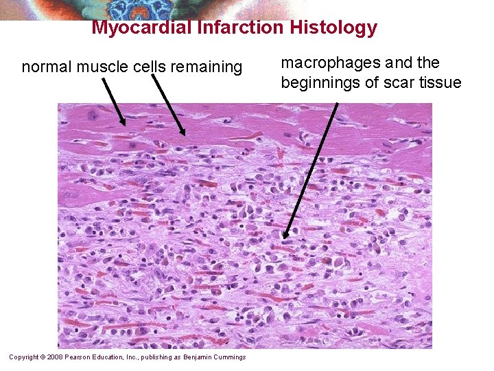 Myocardial Infarction Histology normal muscle cells remaining Copyright © 2008 Pearson Education, Inc. ,