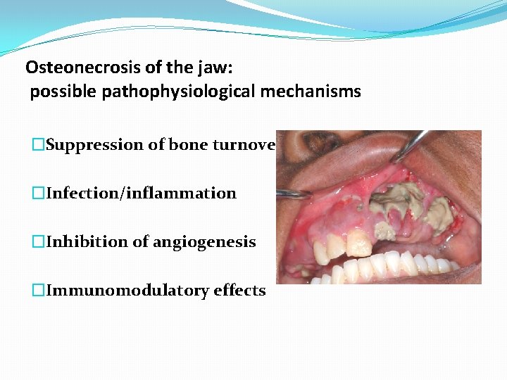 Osteonecrosis of the jaw: possible pathophysiological mechanisms �Suppression of bone turnover �Infection/inflammation �Inhibition of