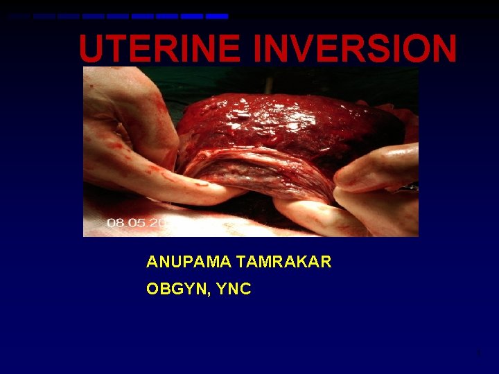 UTERINE INVERSION ANUPAMA TAMRAKAR OBGYN, YNC 1 