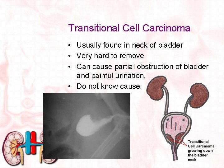 Transitional Cell Carcinoma • Usually found in neck of bladder • Very hard to