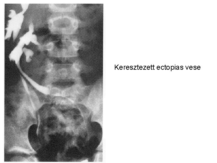 Keresztezett ectopias vese 