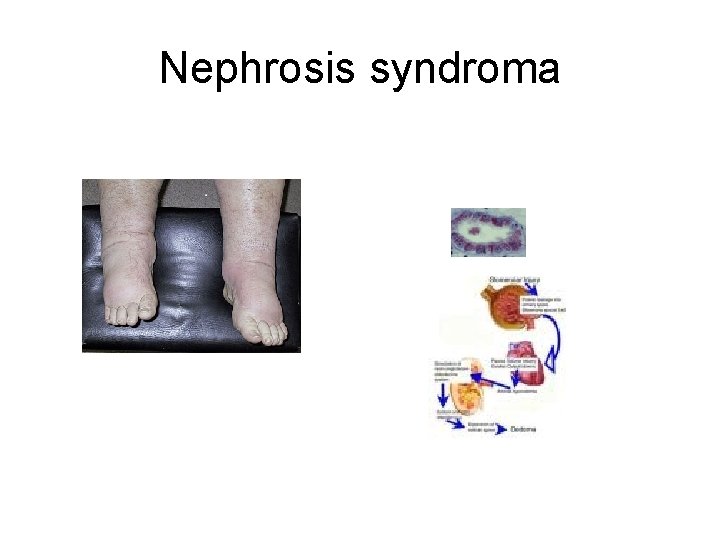 Nephrosis syndroma 