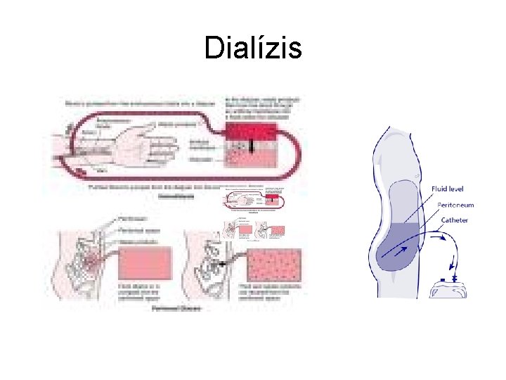 Dialízis 