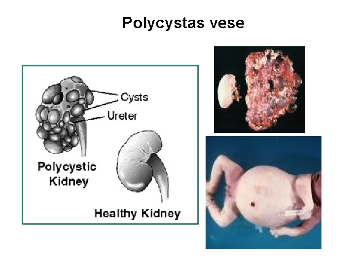 Polycystas vese 