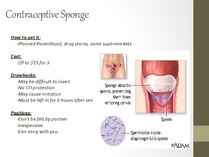 Contraceptive Sponge How to get it: -Planned Parenthood, drug stores, some supermarkets Cost: -$9