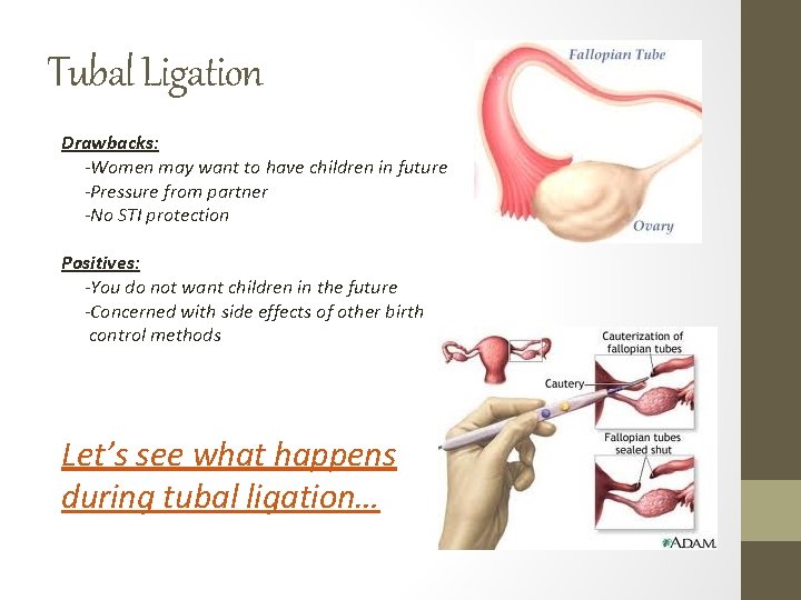 Tubal Ligation Drawbacks: -Women may want to have children in future -Pressure from partner