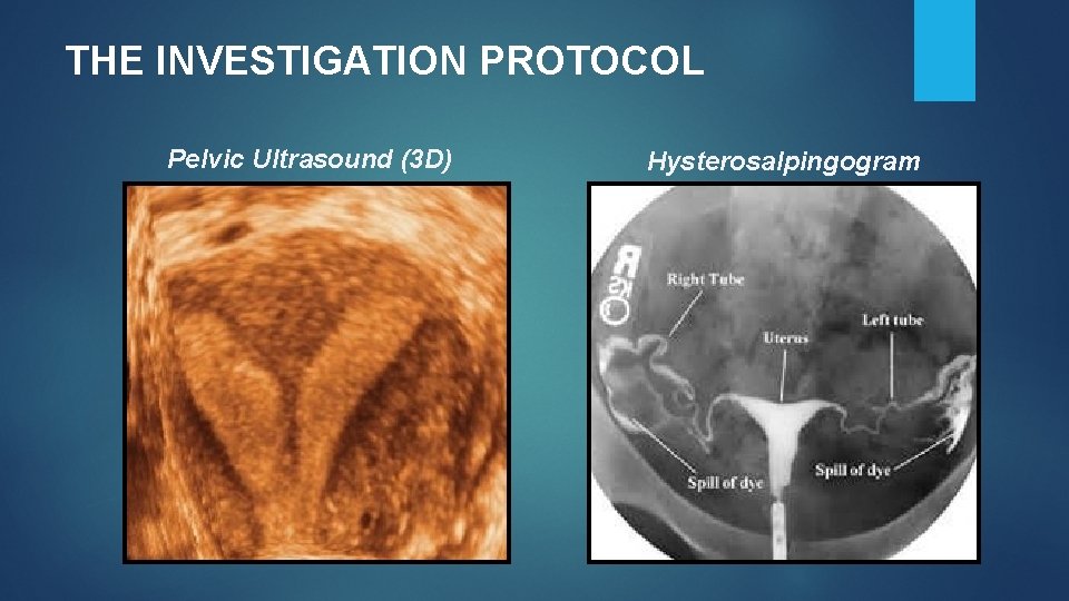 THE INVESTIGATION PROTOCOL Pelvic Ultrasound (3 D) Hysterosalpingogram THE INVESTIGATION PROTOCOL Pelvic Ultrasound (3 D) Hysterosalpingogram