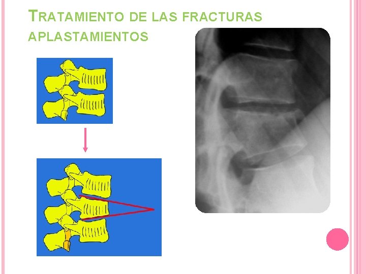 TRATAMIENTO DE LAS FRACTURAS APLASTAMIENTOS Aplastamiento anterior Pared posterior conservada TRATAMIENTO DE LAS FRACTURAS APLASTAMIENTOS Aplastamiento anterior Pared posterior conservada