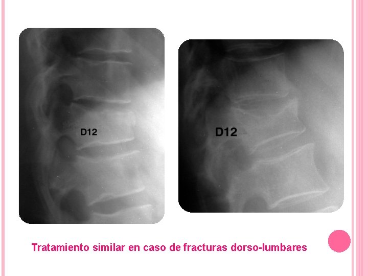 Tratamiento similar en caso de fracturas dorso-lumbares 