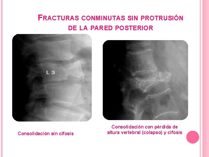 FRACTURAS CONMINUTAS SIN PROTRUSIÓN DE LA PARED POSTERIOR Consolidación sin cifosis Consolidación con pérdida