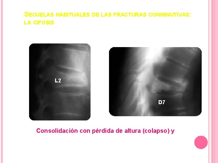 SECUELAS HABITUALES DE LAS FRACTURAS CONMINUTIVAS: LA CIFOSIS L 2 D 7 Consolidación con