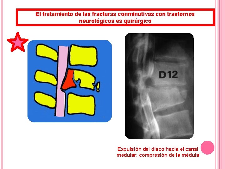 El tratamiento de las fracturas conminutivas con trastornos neurológicos es quirúrgico Compresión de un