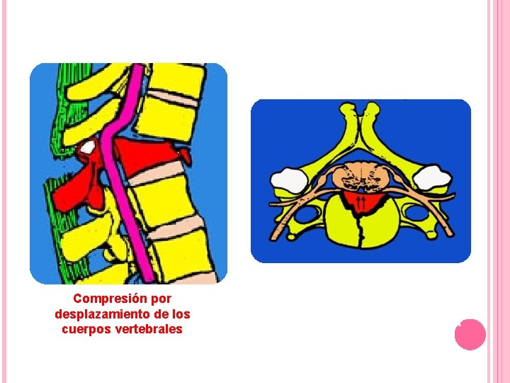 Trastornos neurológicos Compresión por desplazamiento de los cuerpos vertebrales Elementos compresivos en el canal