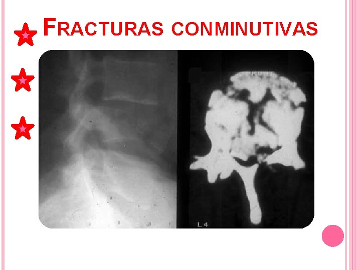 FRACTURAS CONMINUTIVAS Elementos compresivos del canal medular Evaluación por TAC o RMN FRACTURAS CONMINUTIVAS Elementos compresivos del canal medular Evaluación por TAC o RMN