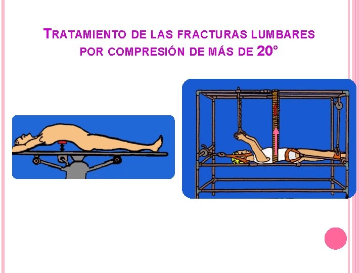 TRATAMIENTO DE LAS FRACTURAS LUMBARES POR COMPRESIÓN DE MÁS DE 20° Reducción en lordosis TRATAMIENTO DE LAS FRACTURAS LUMBARES POR COMPRESIÓN DE MÁS DE 20° Reducción en lordosis
