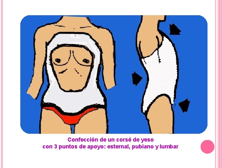 Confección de un corsé de yeso con 3 puntos de apoyo: esternal, pubiano y Confección de un corsé de yeso con 3 puntos de apoyo: esternal, pubiano y