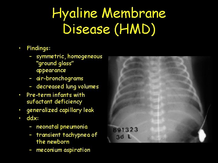 Hyaline Membrane Disease (HMD) • Findings: – symmetric, homogeneous “ground glass” appearance – air-bronchograms