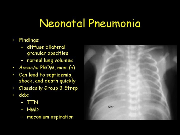 Neonatal Pneumonia • Findings: – diffuse bilateral granular opacities – normal lung volumes •