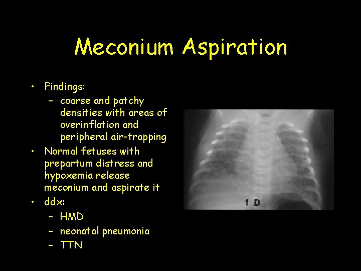 Meconium Aspiration • Findings: – coarse and patchy densities with areas of overinflation and