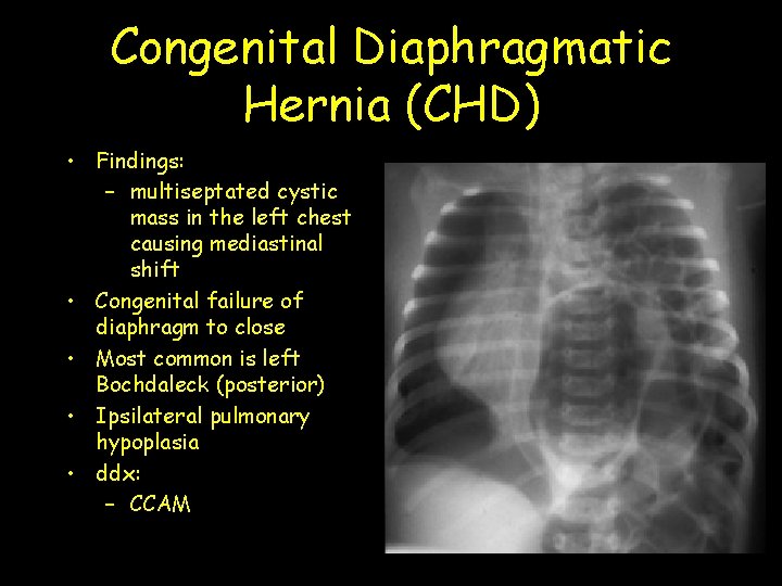 Congenital Diaphragmatic Hernia (CHD) • Findings: – multiseptated cystic mass in the left chest