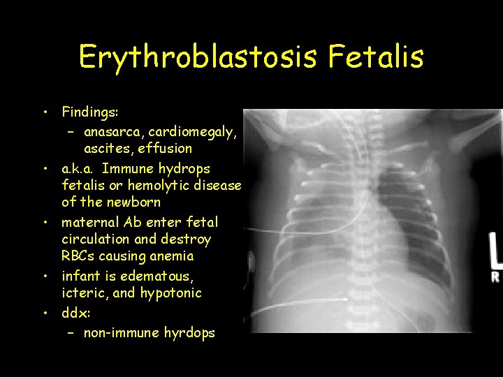 Erythroblastosis Fetalis • Findings: – anasarca, cardiomegaly, ascites, effusion • a. k. a. Immune