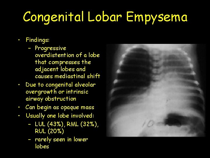 Congenital Lobar Empysema • Findings: – Progressive overdistention of a lobe that compresses the