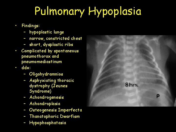 Pulmonary Hypoplasia • • • Findings: – hypoplastic lungs – narrow, constricted chest –