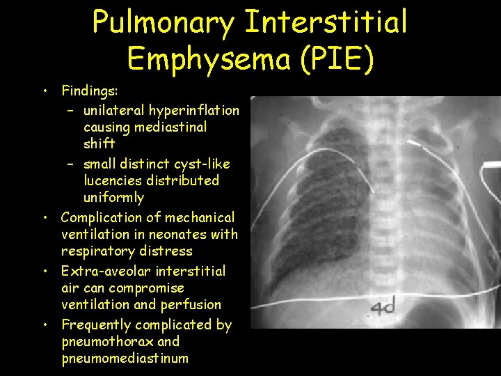 Pulmonary Interstitial Emphysema (PIE) • Findings: – unilateral hyperinflation causing mediastinal shift – small