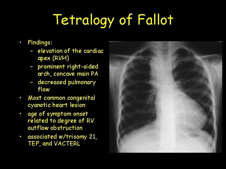Tetralogy of Fallot • Findings: – elevation of the cardiac apex (RVH) – prominent