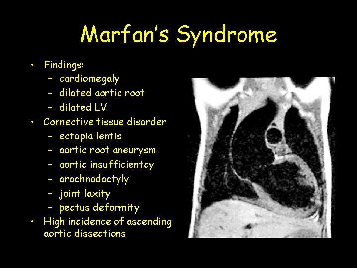 Marfan’s Syndrome • Findings: – cardiomegaly – dilated aortic root – dilated LV •