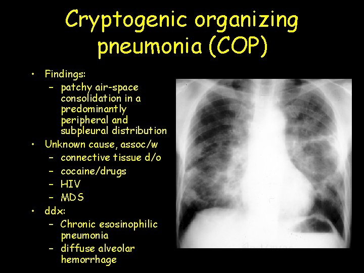 Cryptogenic organizing pneumonia (COP) • Findings: – patchy air-space consolidation in a predominantly peripheral