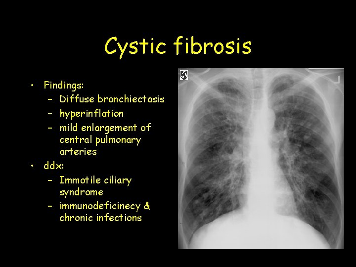 Cystic fibrosis • Findings: – Diffuse bronchiectasis – hyperinflation – mild enlargement of central