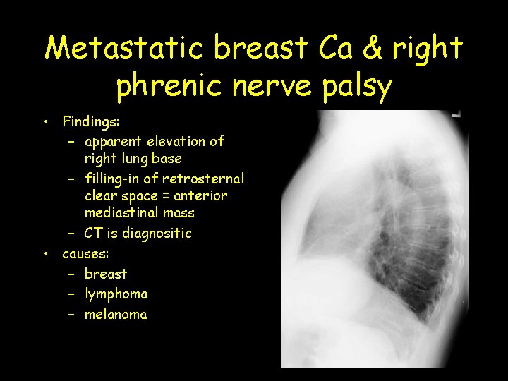 Metastatic breast Ca & right phrenic nerve palsy • Findings: – apparent elevation of
