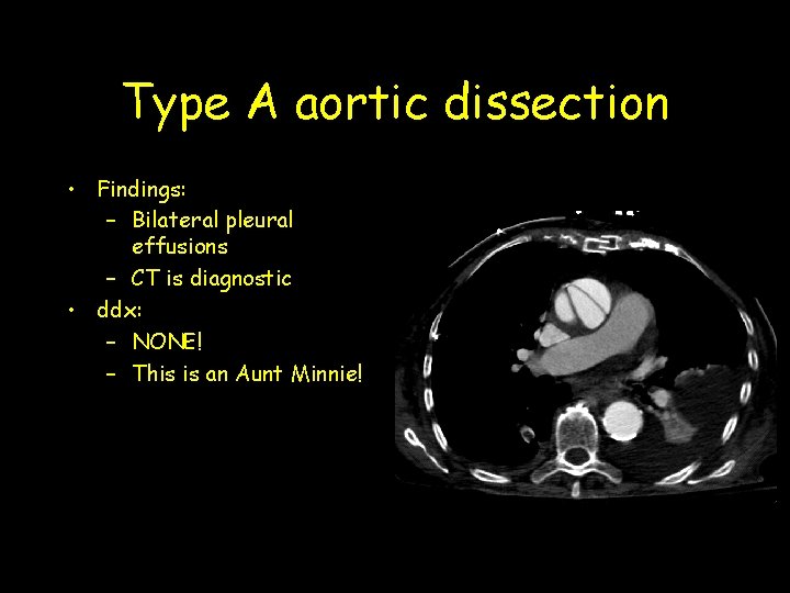 Type A aortic dissection • Findings: – Bilateral pleural effusions – CT is diagnostic