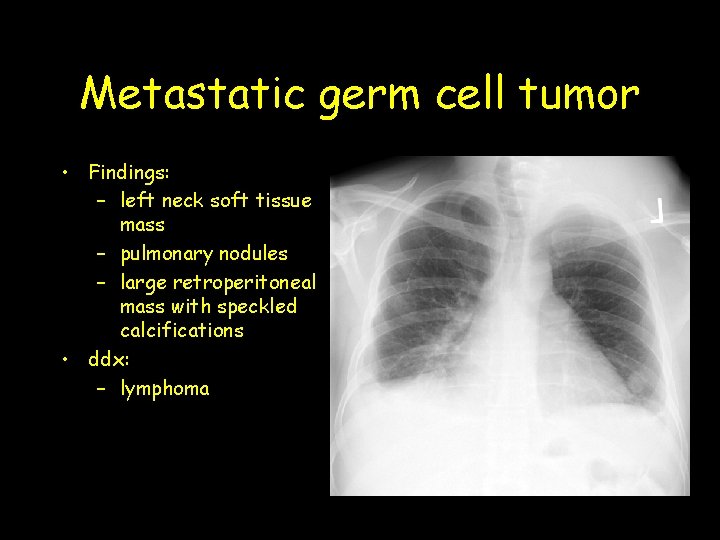 Metastatic germ cell tumor • Findings: – left neck soft tissue mass – pulmonary