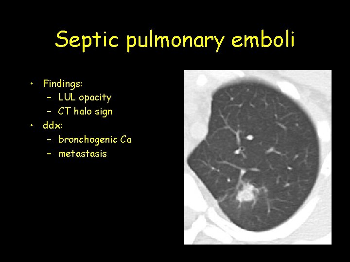 Septic pulmonary emboli • Findings: – LUL opacity – CT halo sign • ddx: