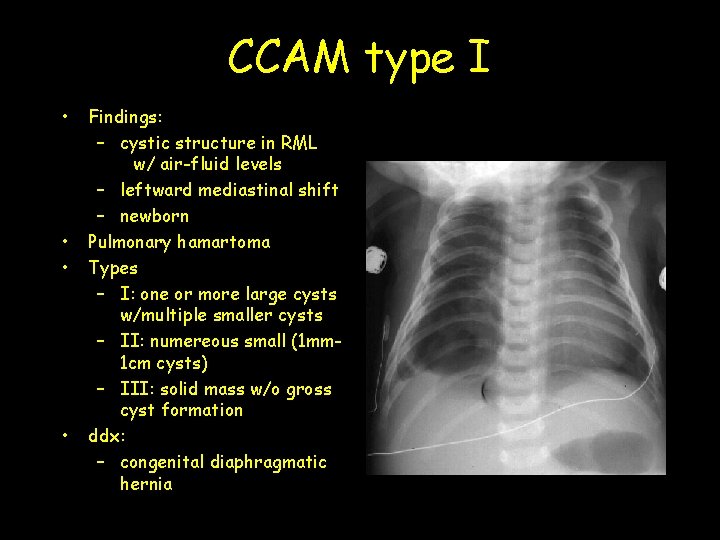 CCAM type I • • Findings: – cystic structure in RML w/ air-fluid levels