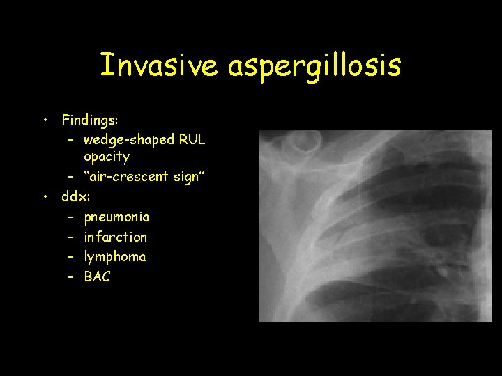 Invasive aspergillosis • Findings: – wedge-shaped RUL opacity – “air-crescent sign” • ddx: –
