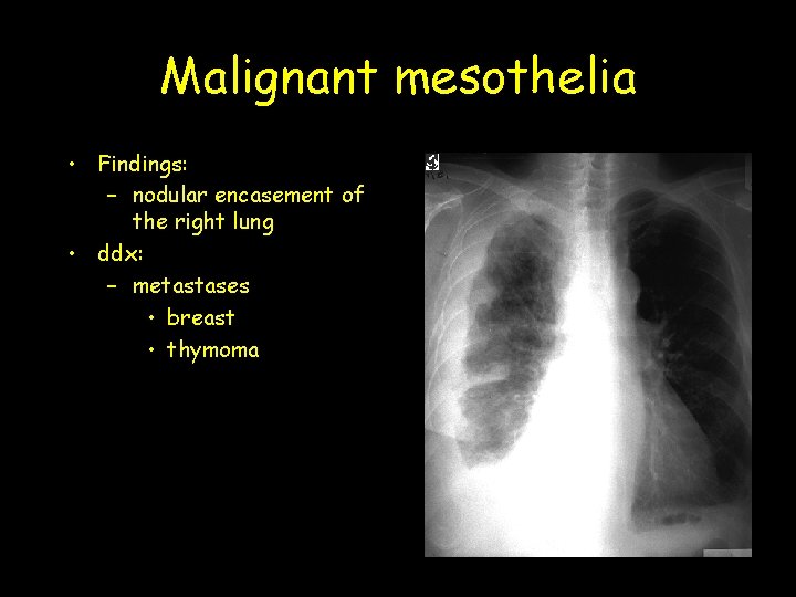 Malignant mesothelia • Findings: – nodular encasement of the right lung • ddx: –